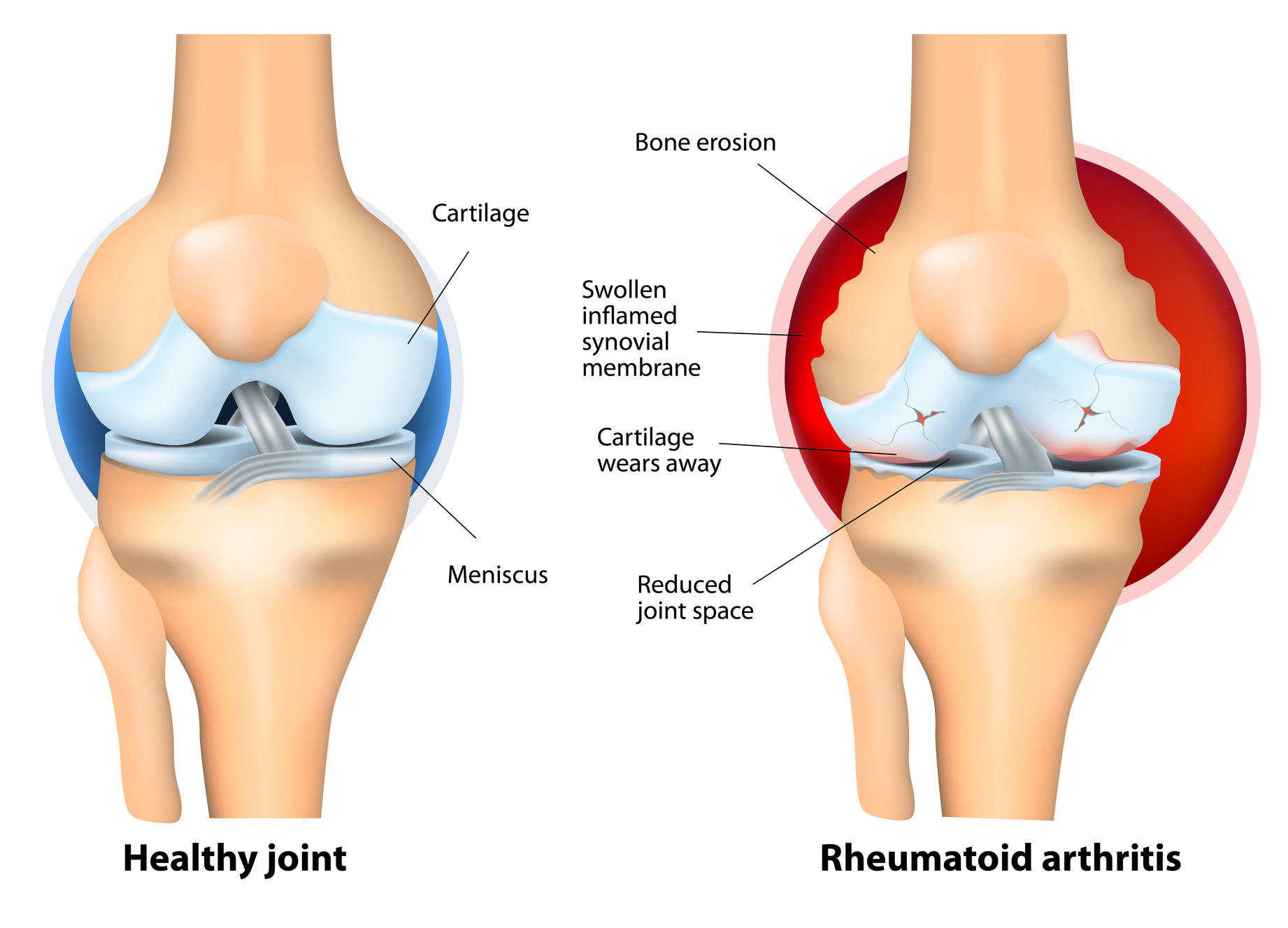 What Kind of Arthritis Is Ankylosing Spondylitis What Kind of Arthritis Is Ankylosing Spondylitis