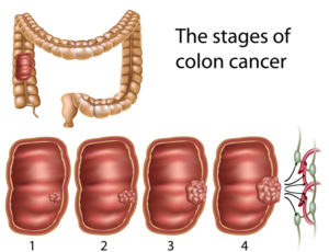 Chronic Intestinal Inflammation And Colon Cancer - Magaziner