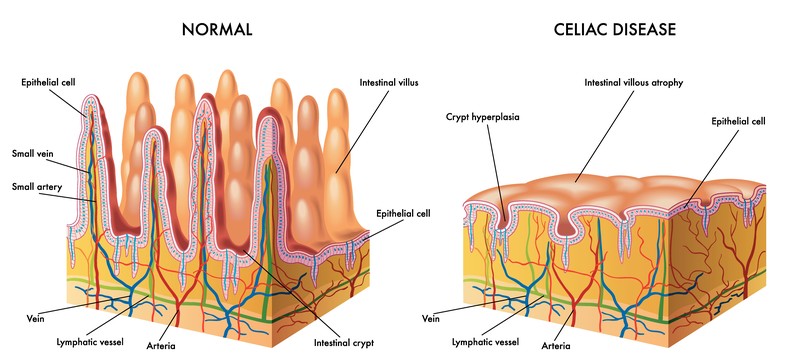 Celiac Disease and Worsening Osteoarthritis and ...