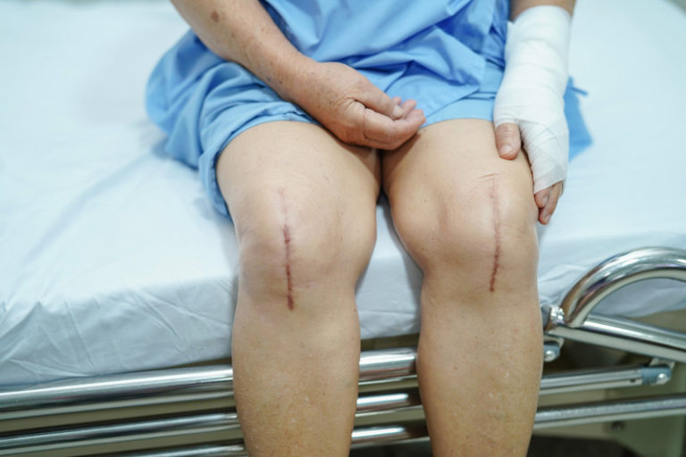 Knee Replacement Complications in Postmenopausal Women