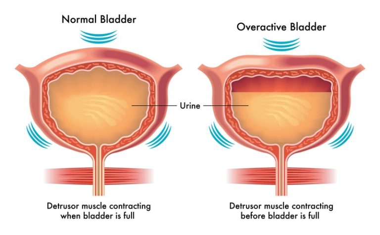 overactive bladder medication